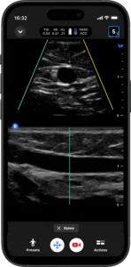 Butterfly iQ3 Handheld Ultrasound | Advanced Portable Imaging