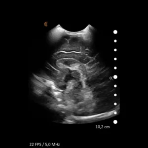 Peds_Neo-Head-Sag-ML_C7_HD3_Tablet