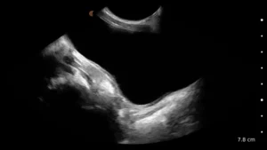 Sag-Bladder-Peds