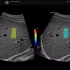 2d-liver-swe-c1-6-d 2d-liver-swe-c1-6-d