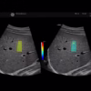 2d-shear-wave-elastography 2d-shear-wave-elastography
