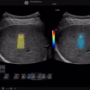 2d-shearwave-with-quality-indicator-liver-c1-6-d