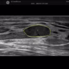 autolesionsegmentationbreastml615rs autolesionsegmentationbreastml615rs