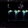 color-flow-and-cw-doppler-mitral-valve-m5sc