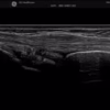extensortendonofwristbmodeml615rs extensortendonofwristbmodeml615rs