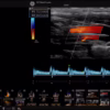 l2-9-carotid-cf-pw