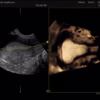 uterusvciomniviewric59ars uterusvciomniviewric59ars